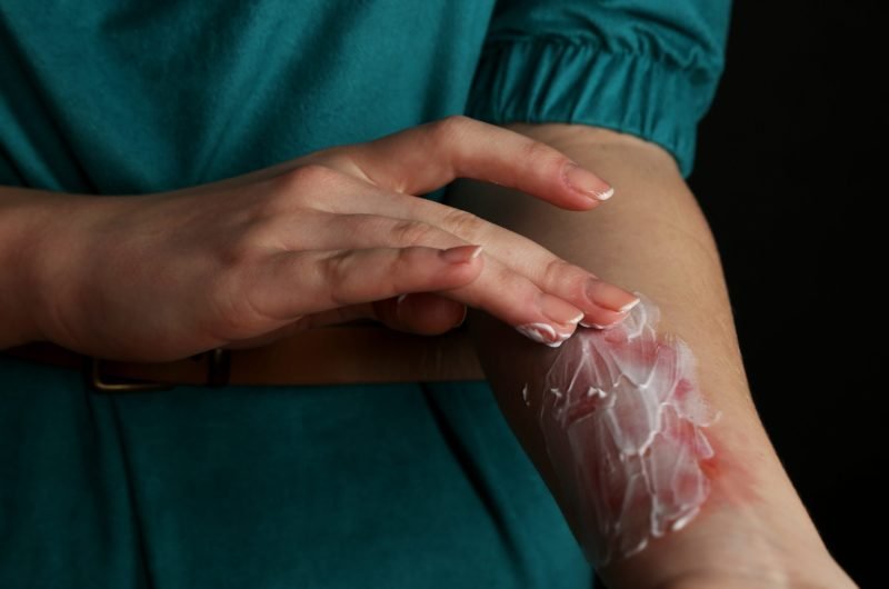 Treatment of burns on female hand on black background